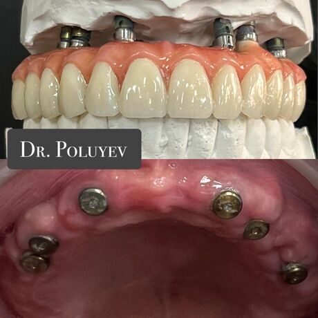 Система «Все на 6» (ALL-on-6) означает восстановление всего зубного ряда на 6 имплантах